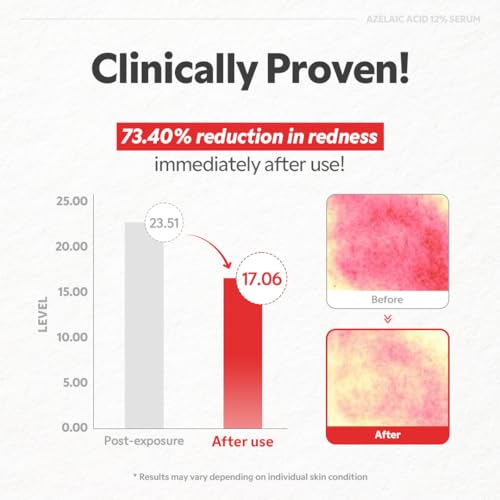 TIRTIR Azelaic Acid 12% Serum for Blemish-Prone Skin - - Product Imagery