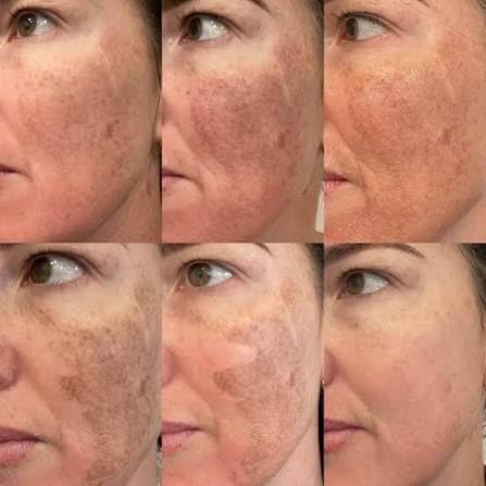 Azzy’s 20% Jessner Chemical Peel - Maximum Professional Strength - Product Imagery
