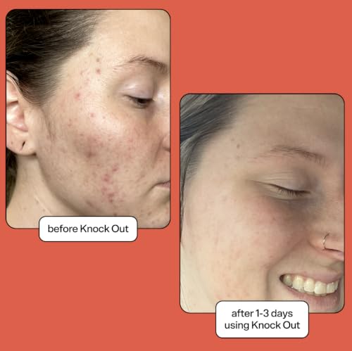 Bubble Skincare Knock Out 1.8% Salicylic Acid Acne Spot - Product Imagery