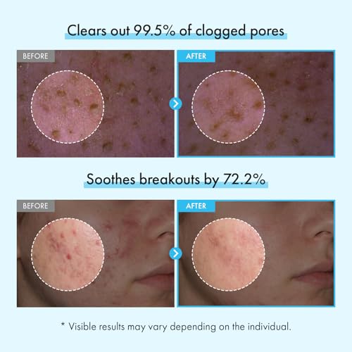 TOSOWOONG Azelaic Acid Niacinamide Face Wash for Blemish-Prone - Product Imagery