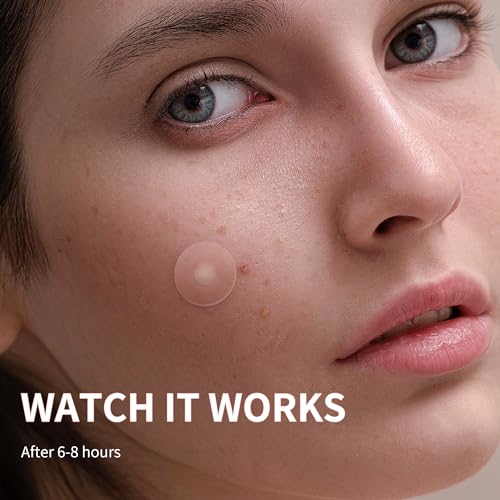 Daolyo Pimple Patches for Face, 4 Size 300 Counts Hydrocolloid - Product Imagery
