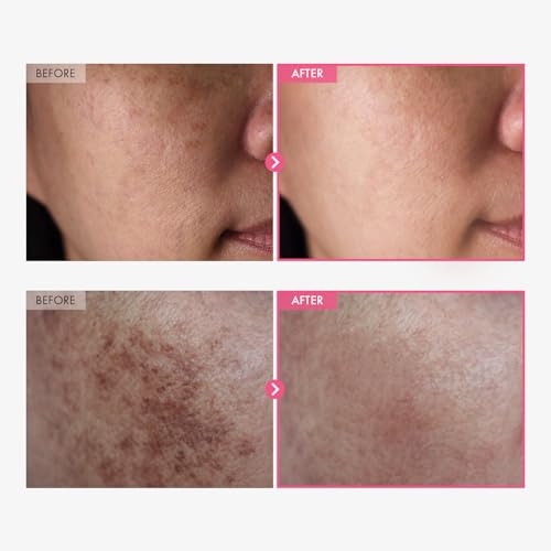 TOSOWOONG Arbutin 7% + Tranexamic Acid 4% Cream for Dark Spots, - Product Imagery