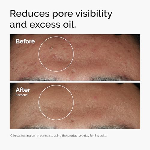 The Ordinary Niacinamide 10% + Zinc 1%, Smoothing Serum for - Product Imagery