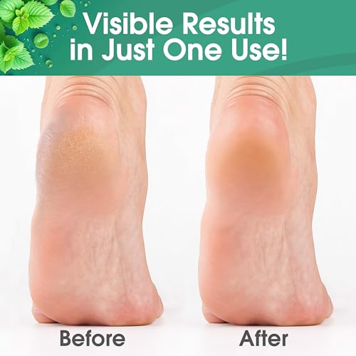 DeEnti Foot Callus Remover Gel, Dead Skin Remover for Feet, 8oz - Product Imagery