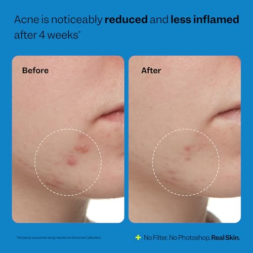 Peach Slices - Acne Exfoliating Toner (4.05 oz) - 2% Salicylic - Product Imagery