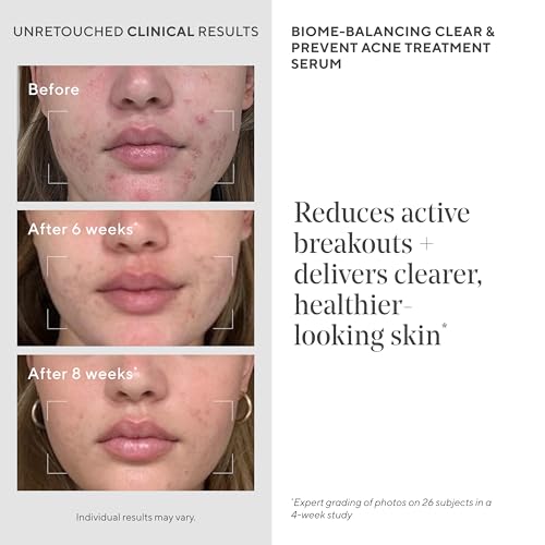Murad Biome-Balancing Acne Serum - Mandelic & Salicylic Acid - 1 - Product Imagery