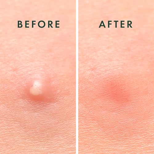 Rael Miracle Invisible Spot Cover Hydrocolloid Acne Pimple - Product Imagery