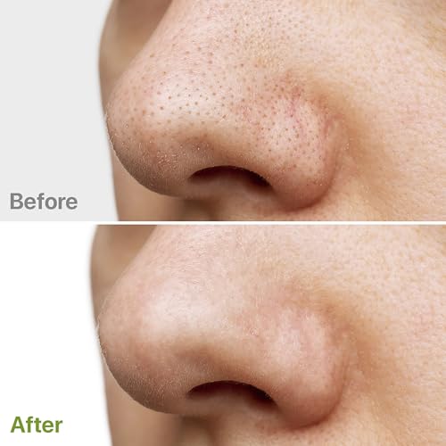 Glycolic Acid Resurfacing Pads - Facial Exfoliating Peel for - Product Imagery