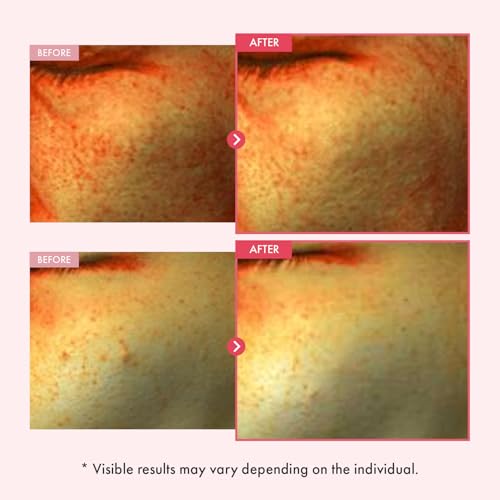 TOSOWOONG Niacinamide 10% + Arbutin 7% Serum for Dark Spots & - Product Imagery