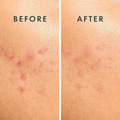 Rael Miracle Spot Control Cover Hydrocolloid Strips Pimple - Product Imagery