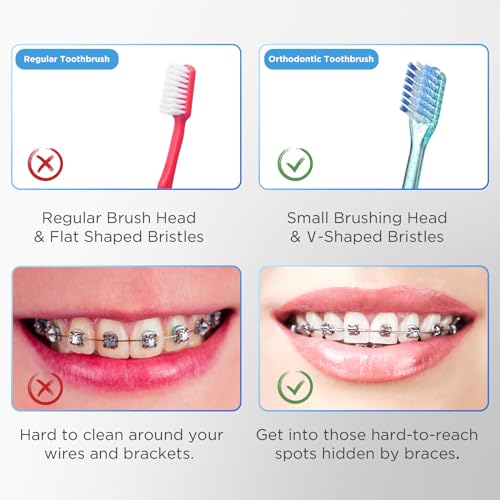 Fregum V-Shaped Orthodontic Toothbrush for Braces with - Product Imagery