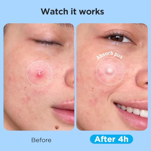 504 Counts 4 Sizes Hydrocolloid Pimple Patches for Face - Product Imagery