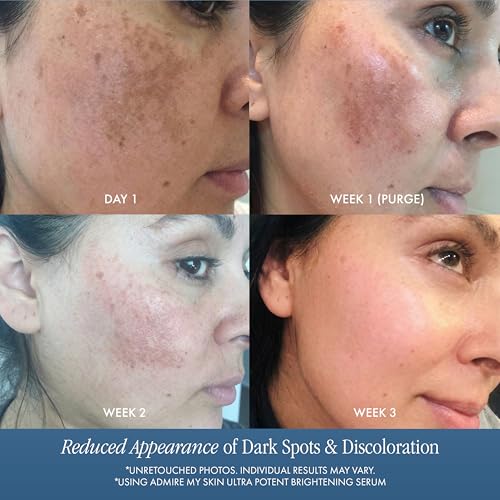 Admire My Skin Dark Spot Corrector Remover for Face Brightening - Product Imagery