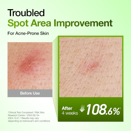 Anua Azelaic Acid 10 Hyaluron Redness Soothing Serum, 1.01 fl oz - Product Imagery