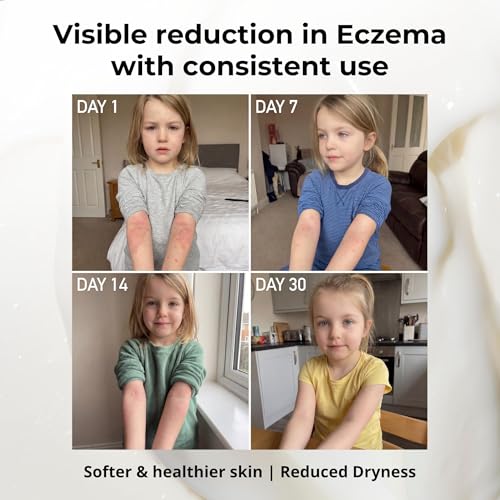 Miracle Manuka Eczema Cream for Dry Skin - Product Imagery