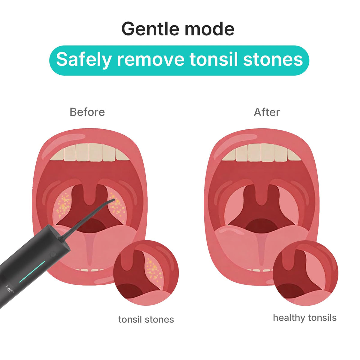 bigsmile Water Flosser Safe Tonsil Stone Remover Prevent Bad Breath, Black – close-up detail in Black