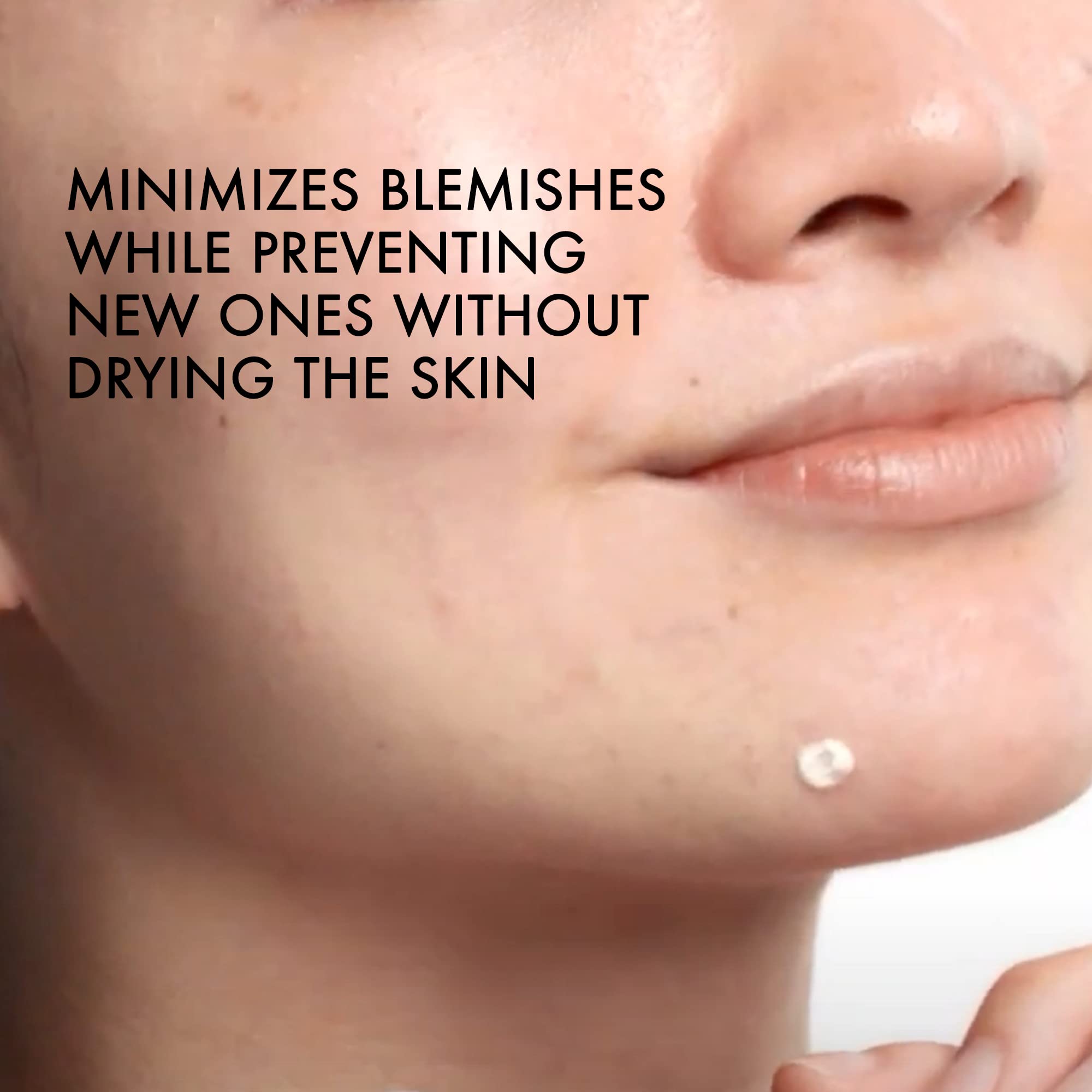 Vichy Normaderm S.O.S Acne Rescue Spot Corrector, Acne Spot Treatment for Face with 10% Sulfur, Niacinamide & Glycolic Acid, Suitable for Sensitive Skin