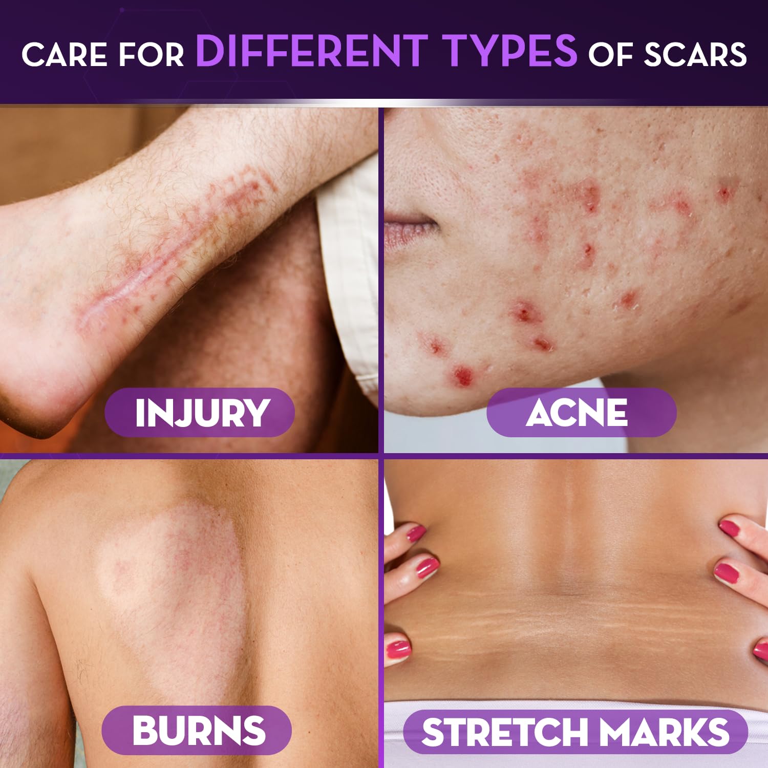 Cicatricure Advanced Scar Gel | 2 oz – Clinically Proven