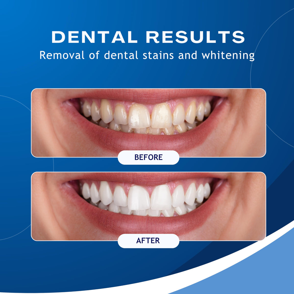 Ultrasonic Electric Teeth Polisher - Premium Selection Official Imagery - 8