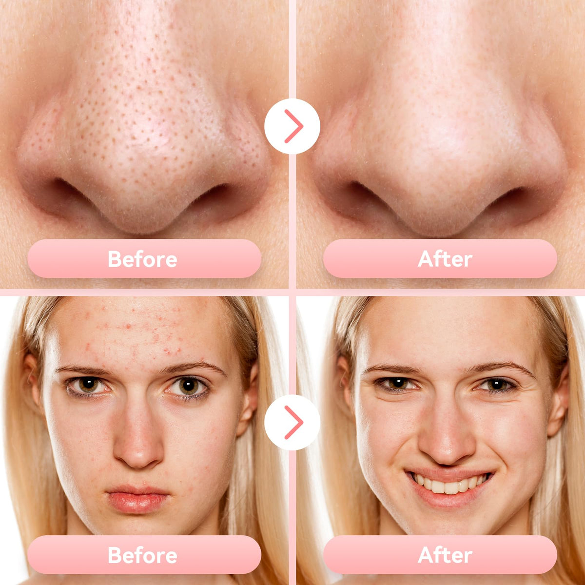 Blackhead Remover Vacuum Facial Pore Extractor 5 Suction - FREESHOW Official Imagery - 6