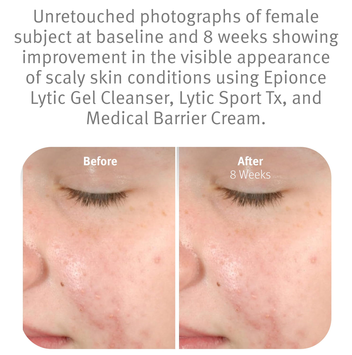 Epionce Lytic Gel Cleanser Gentle Foaming Face Wash Blemish Makeup Remover – full view