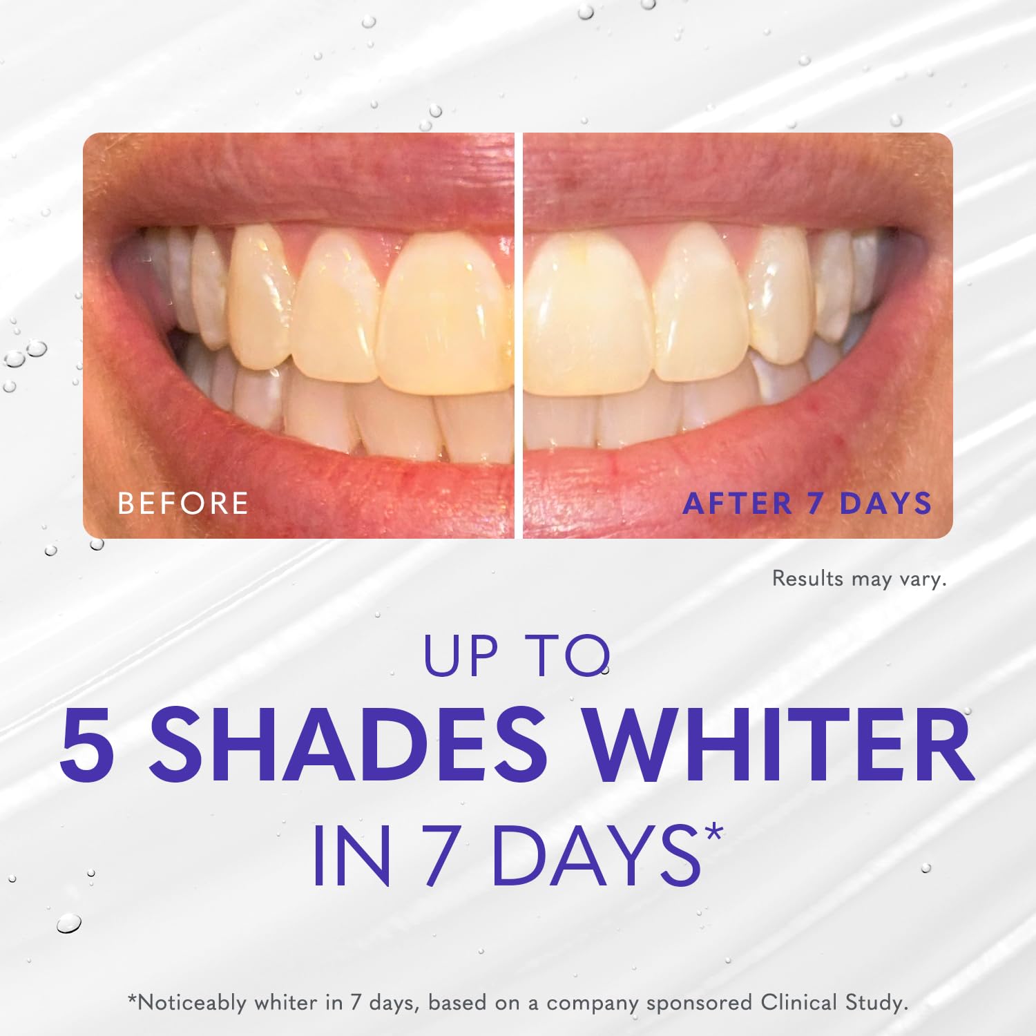 Smileactives Teeth Whitening Gel Kit – 6 Shades Whiter