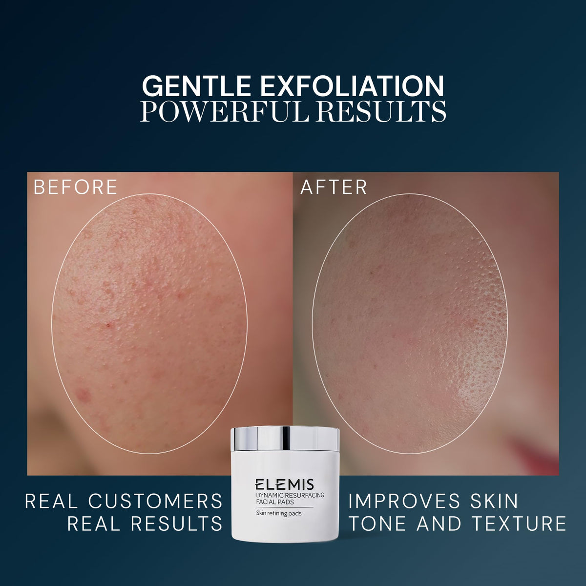 ELEMIS Dynamic Resurfacing Facial Pads Gentle Textured - Premium Selection Official Imagery - 5
