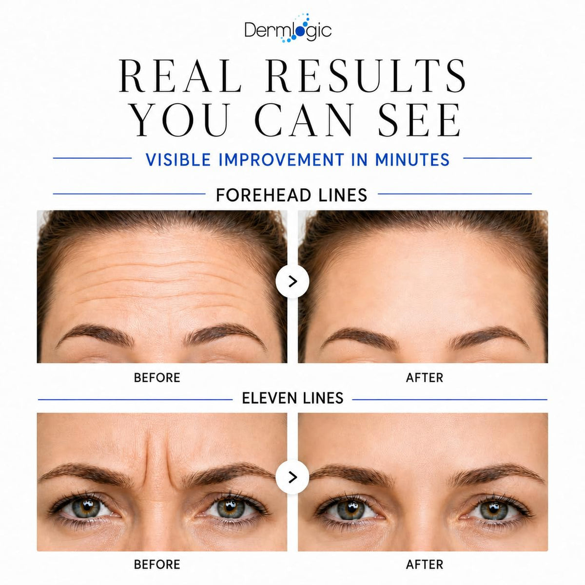 Dermlogic Under Eye Puffiness & Dark Circles Rapid Treatment- Instantly Reduces the Appearance of Puffy Eye Bags, Crow’s