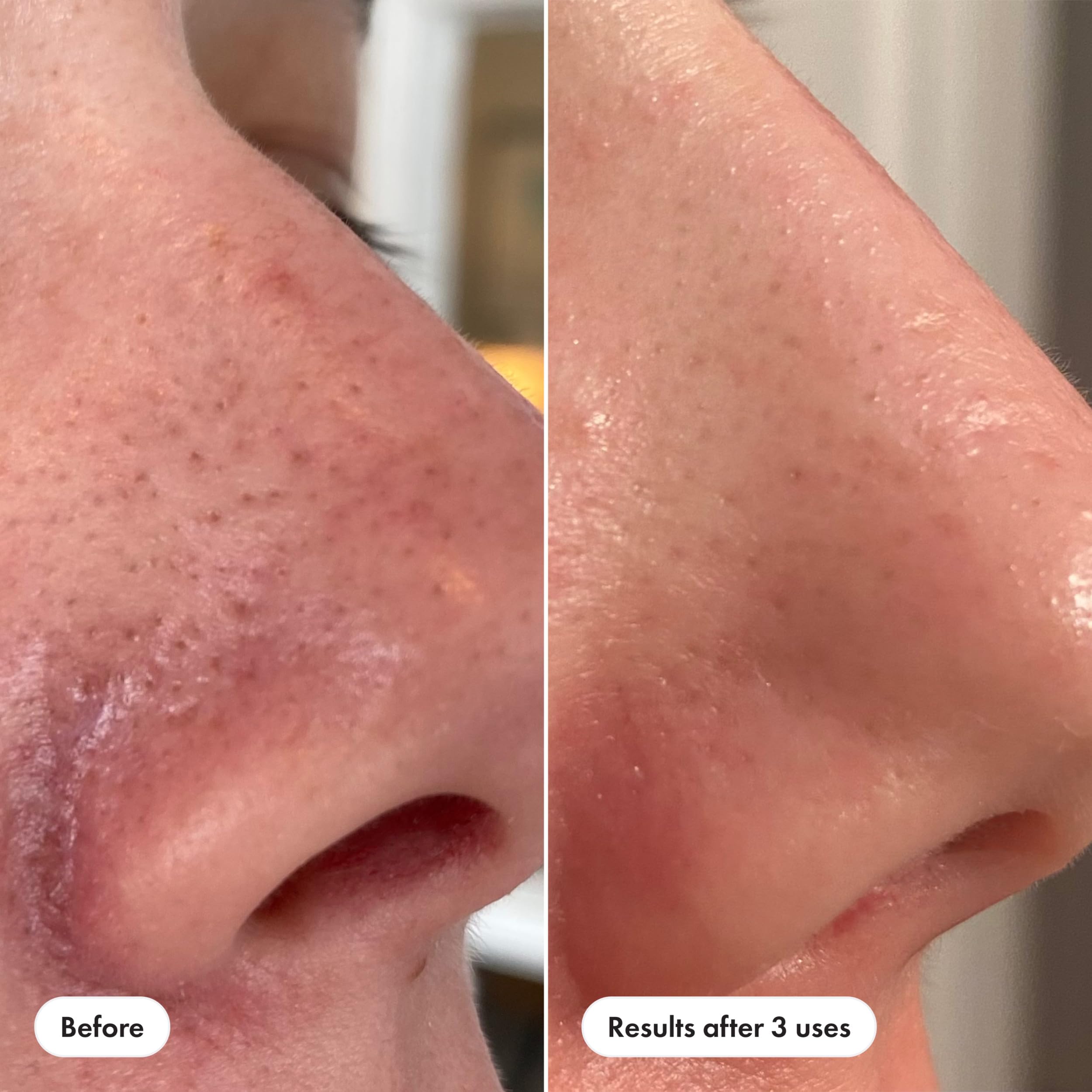 Hero Cosmetics Pore Release blackhead clearing solution in a 3.38 fl oz bottle, designed for deep pore cleansing and blackhead removal.