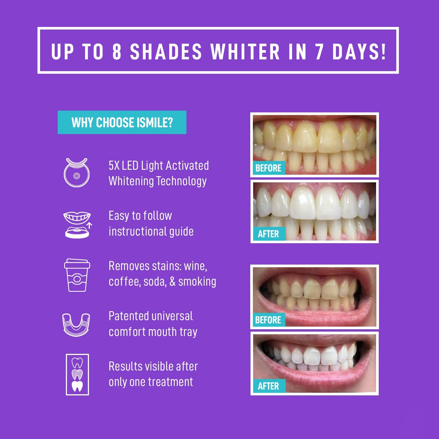 iSmile Teeth Whitening Kit with LED light and 35% Carbamide Peroxide for at-home teeth whitening treatment.