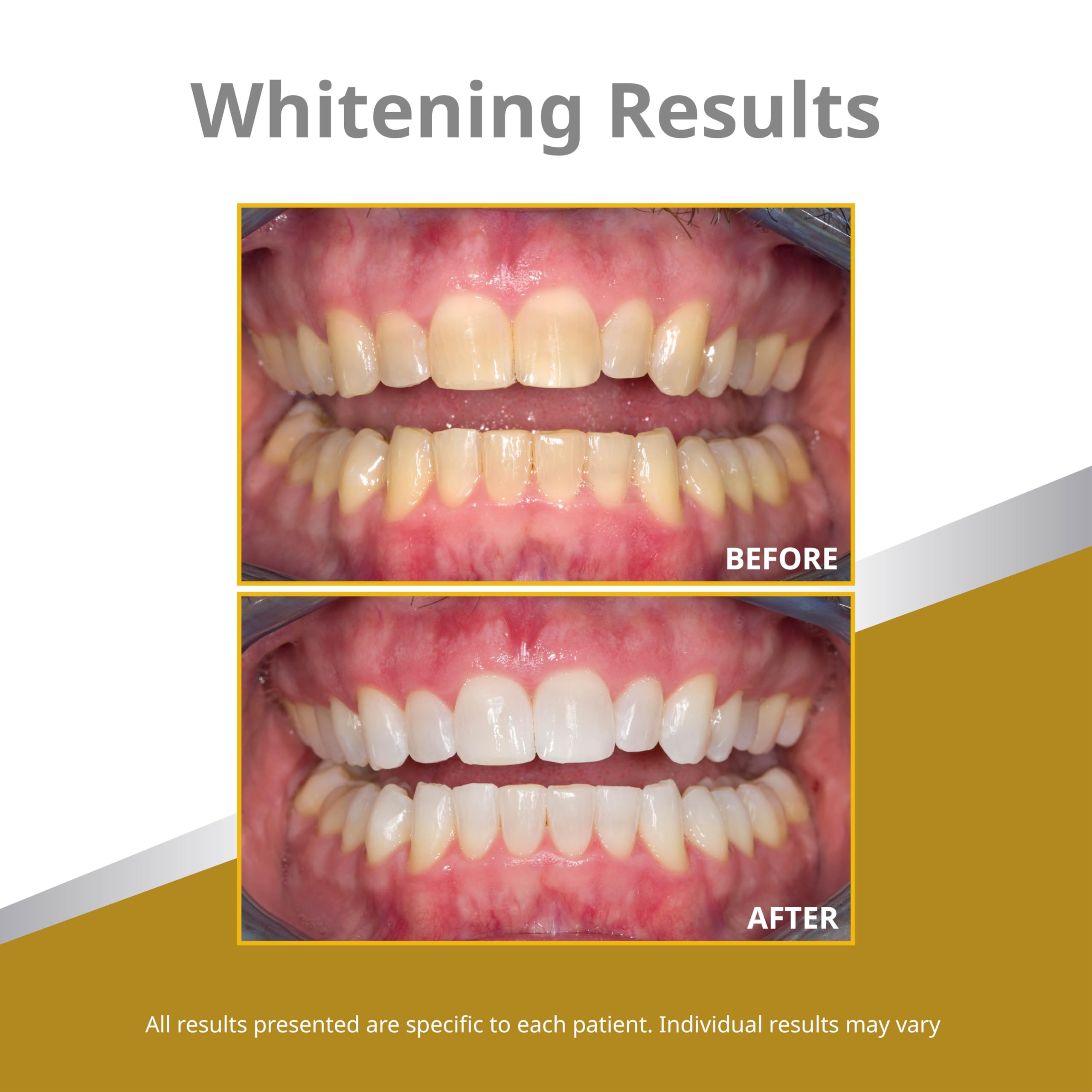 Opalescence 45% teeth whitening gel in four syringes, with a white and blue packaging design, for professional teeth whitening.