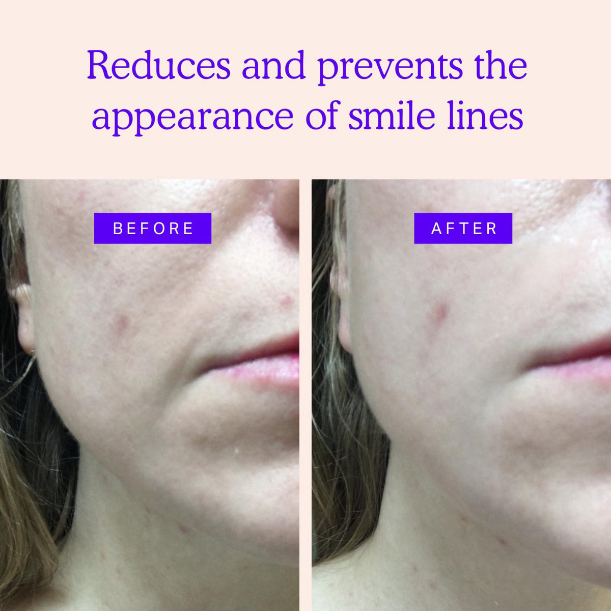 BLUMBODY Smile Line Patches for Marionette Lines, Nasolabial Folds 100 pcs – close-up detail