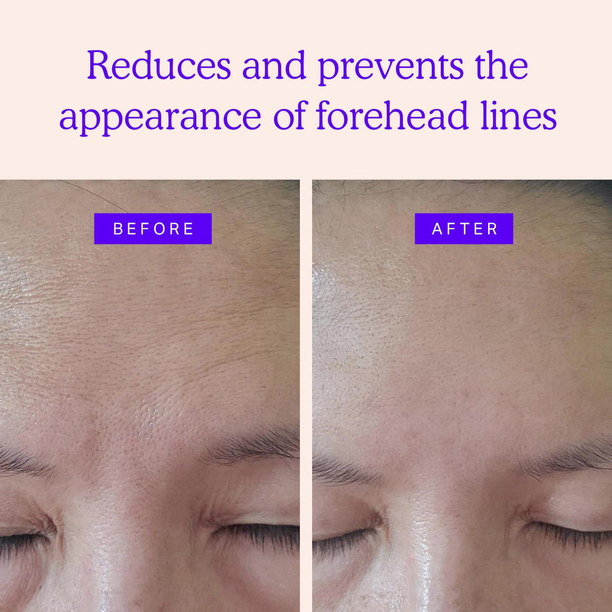 BLUMBODY Face Wrinkle Patches - Forehead and Smile Lines Bundle – full view