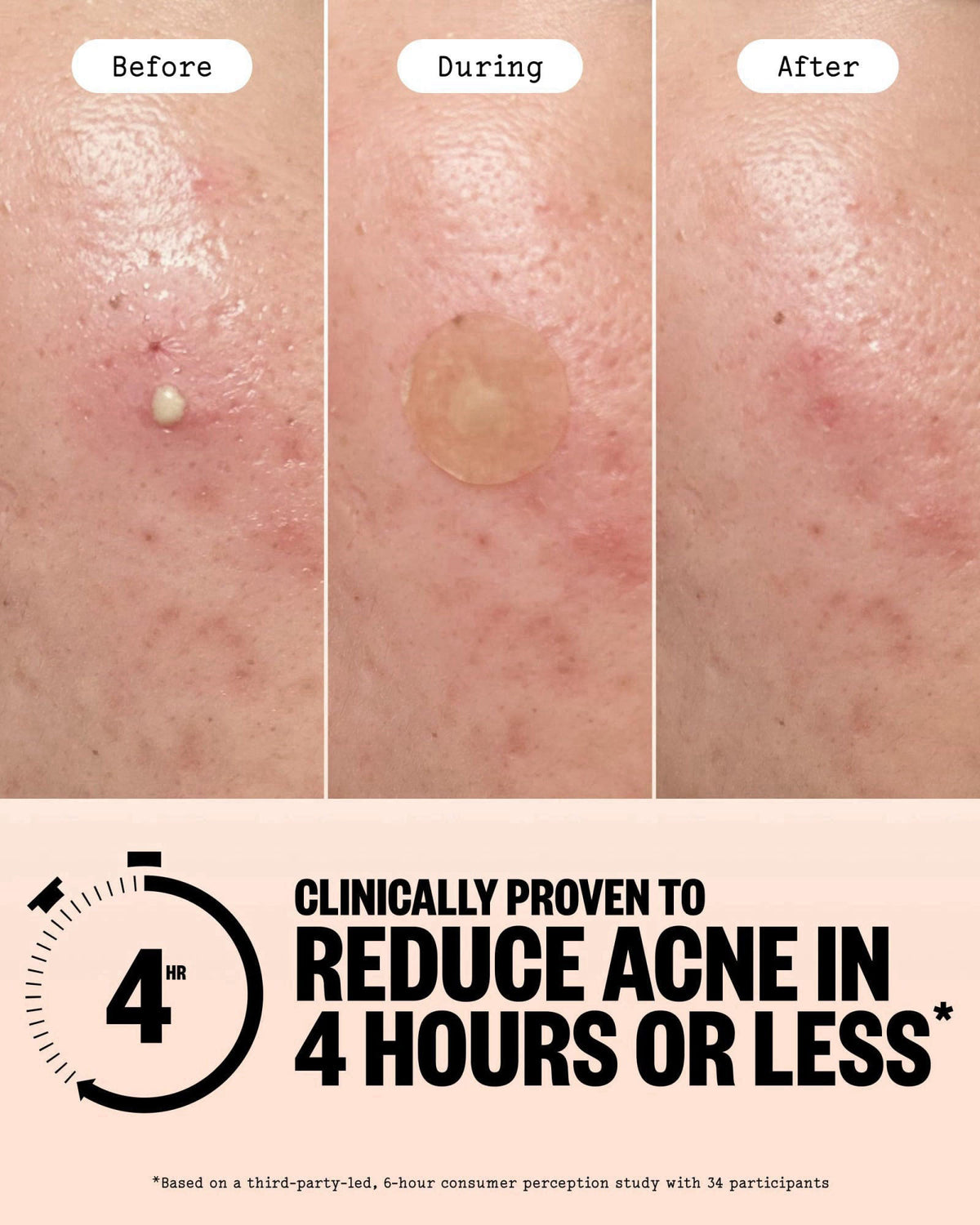 PEACE OUT Acne Healing Dots Medicated Hydrocolloid Pimple Patches (40 ct) – full view