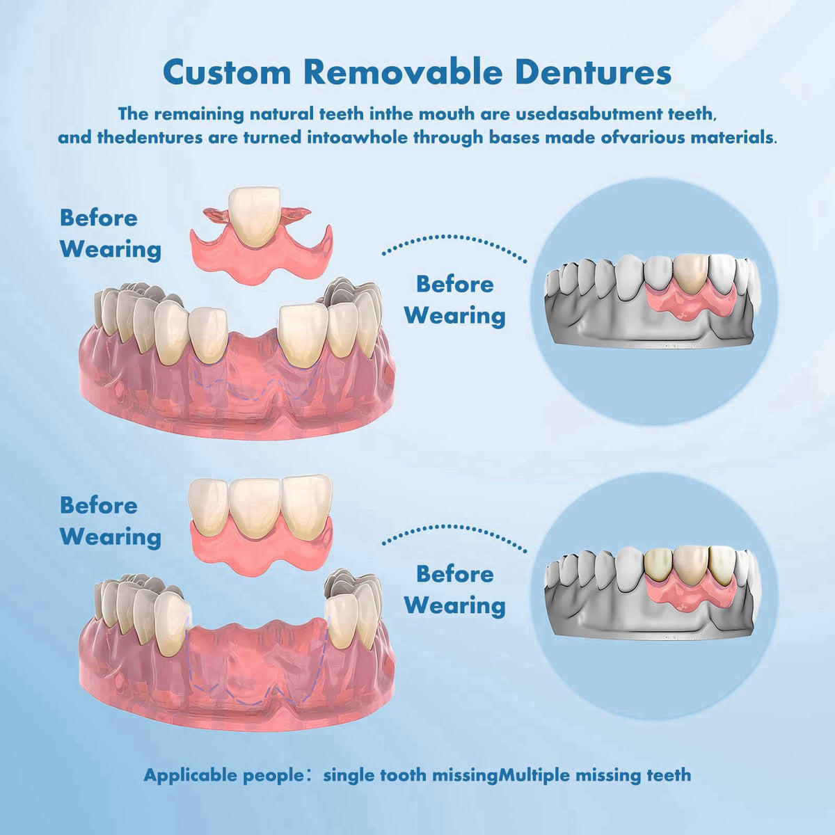 Qiivosm Custom Removable Dentures – Set for Tooth Replacement (1 Tooth) – full view