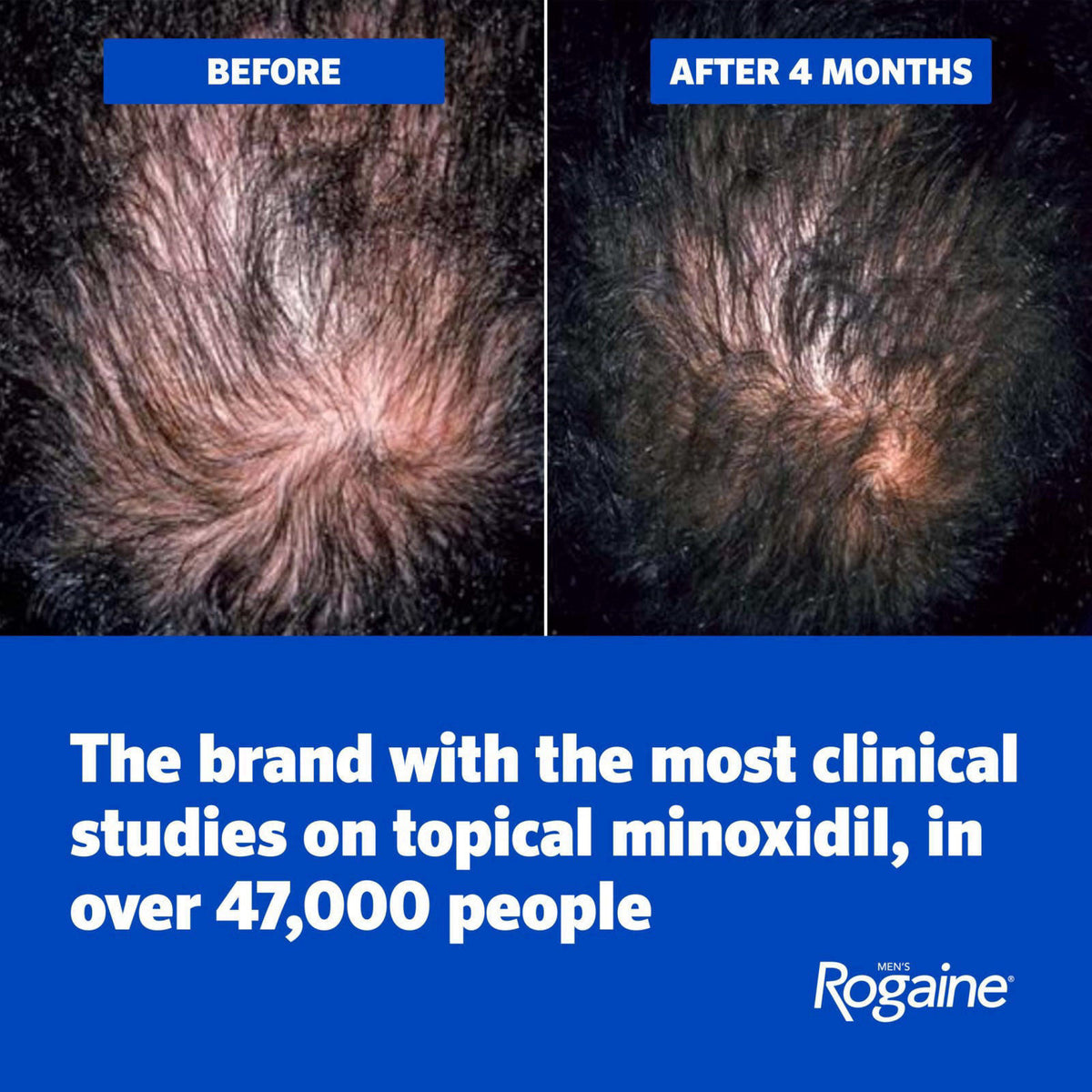 Men's Rogaine 5% Minoxidil Topical Foam, Unscented, 3 x 2.11 oz – full view