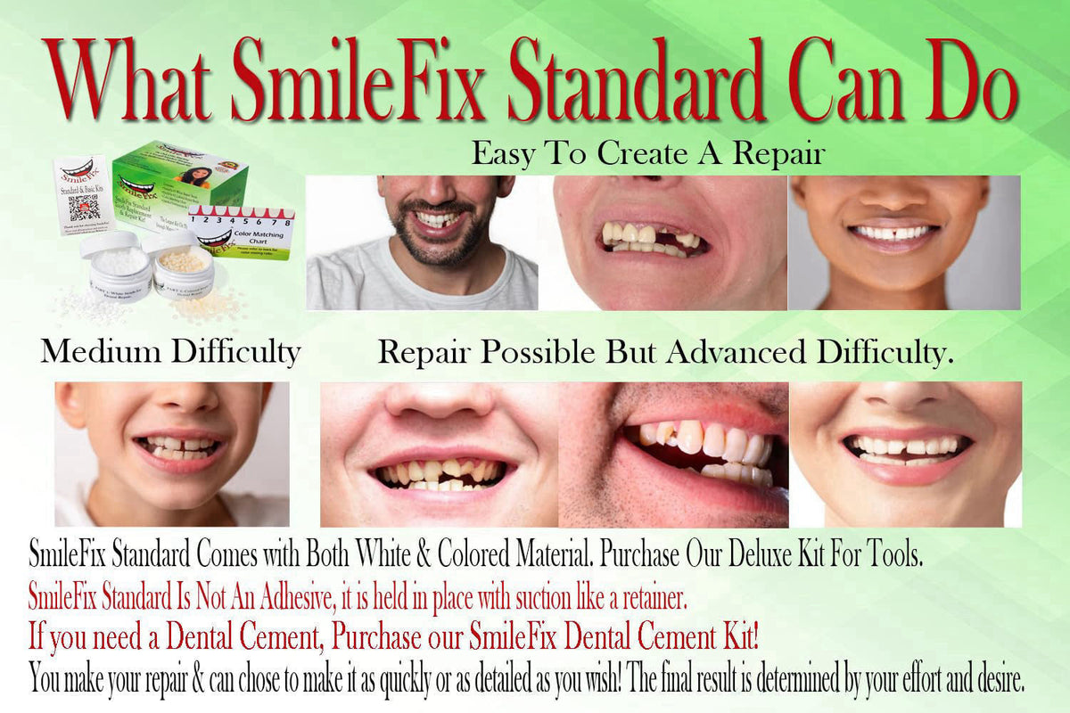 Smile Fix SmileFix Standard Dental Repair Kit - Color Matching Compound - For Missing Or Damaged Teeth - Fix Gaps, Broke