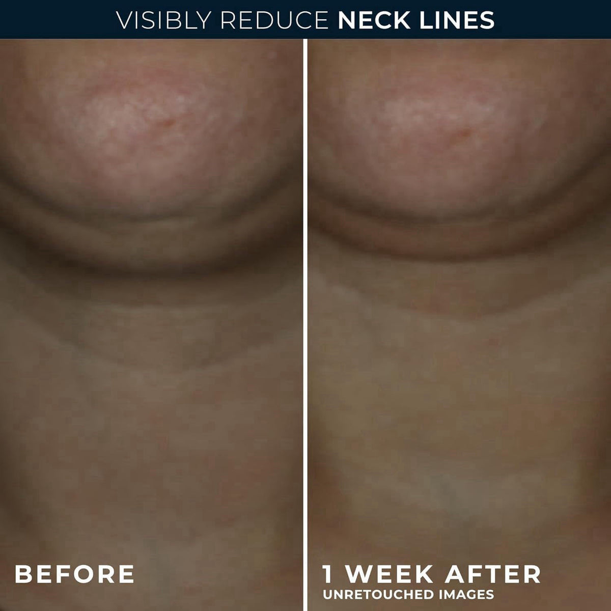 RoC Derm Correxion Neck Cream, Retinol + Hyaluronic Acid, Firming, 1.7 oz – close-up detail