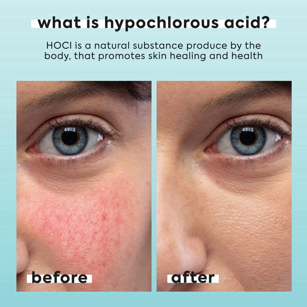 Livaclean 50 CT Large Hydrocolloid Acne Patches & Hypochlorous Acid Spray for Face & Body – alternate angle