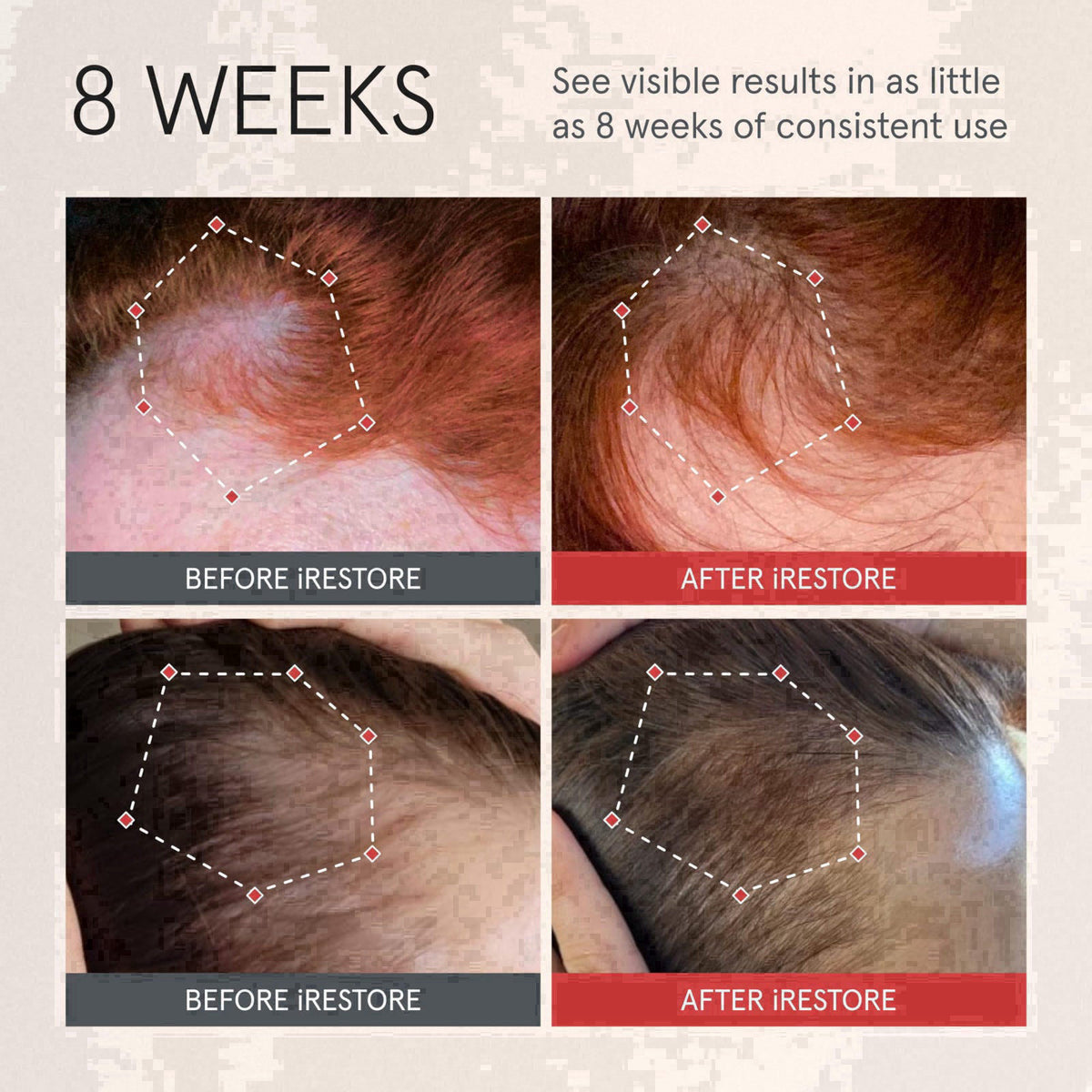 iRESTORE Scalp Serum | Hair Growth Serum for Women Men | Best for Hair Loss Hair Thinning | Aids Regrowth with Redensyl 