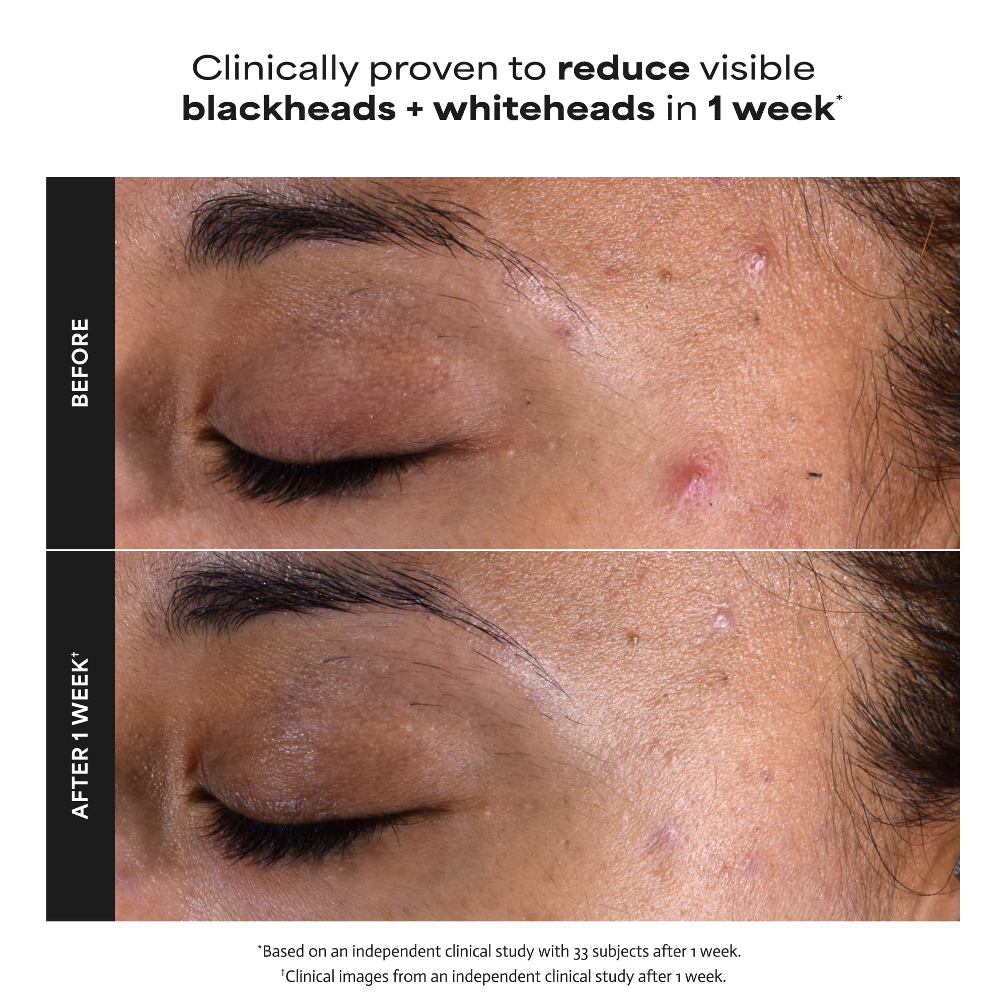 Paula’s Choice Skin Perfecting 2% BHA Liquid Exfoliant in a 4oz bottle, showing the product and label on the packaging.