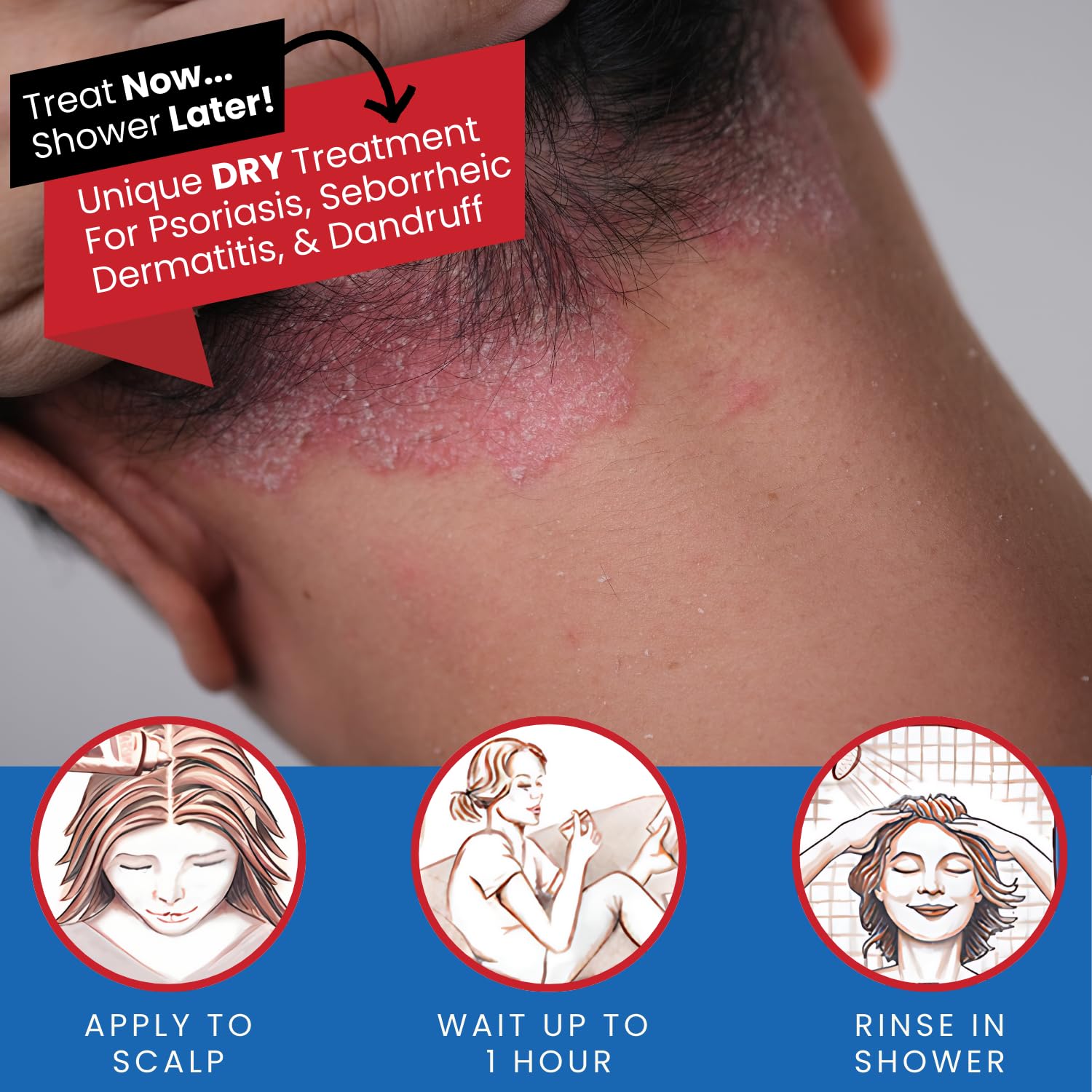 Tarsum Coal Tar Shampoo for scalp psoriasis, 8 oz, natural treatment for scalp irritation, featuring dark liquid shampoo in a bottle.